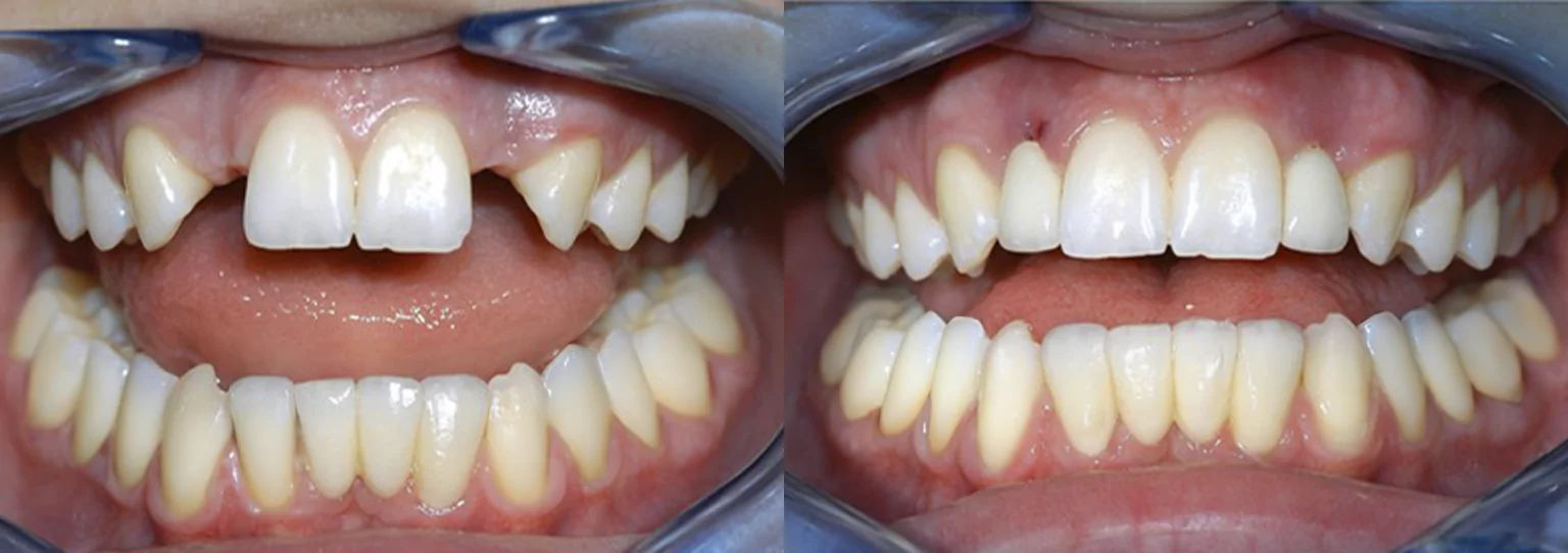 agenesia antes e depois 1536x542.png