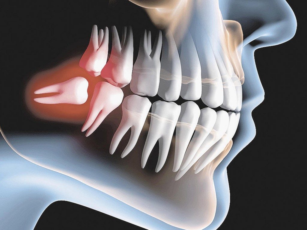 odontocape dente incluso 1024x768 1024x768